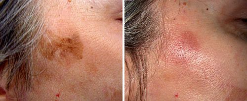 actinic_keratosis_dr_luppino