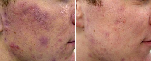 active_acne3_sult_rn