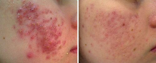 active_acne4_dr_radulaski