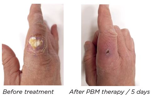 bacterial_cellulitis_treatment_b_a