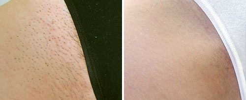 bikini_hair_reduction_dr_blaha