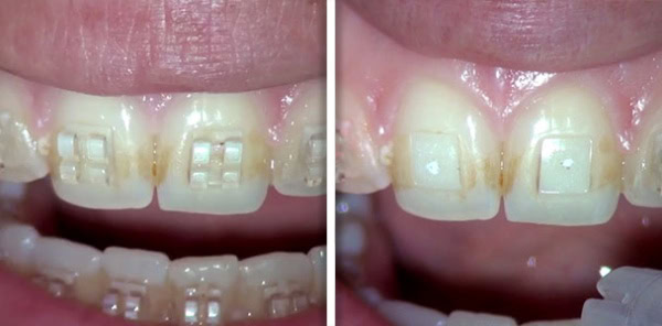 bracket_debonding_tosun