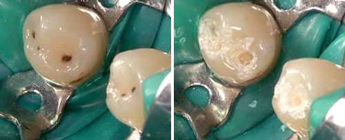 carious_dentine_removal_dr_anic