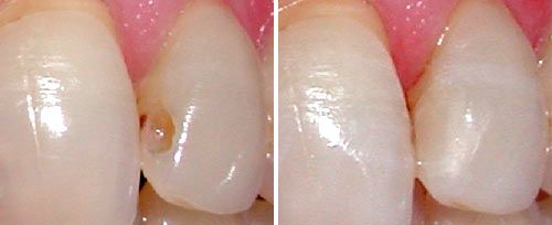 cavity_preparation_dr_semez