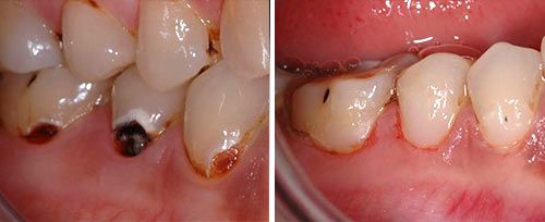 cavity_preparation_kazak