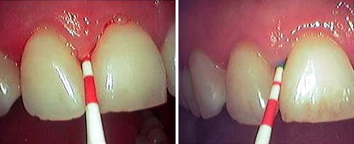 closed_curettage_dr_calvani_0001