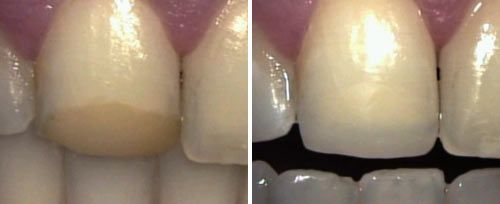composite_material_removal_dr_baldissari