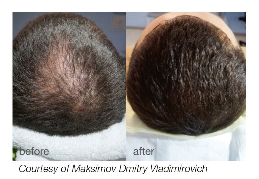 Hair Regrowth Laser Systems for Clinics