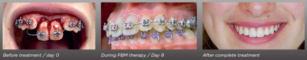 dental_trauma_treatment_b_a