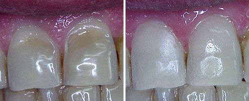 enamel_erosion_dr_fornaini