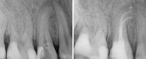 endo_schlichting