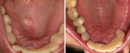 fibrom