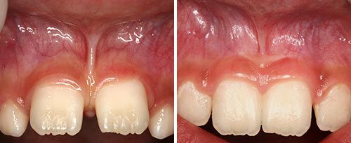 frenectomy_olivi
