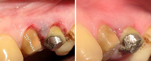 gingival_tattoo_removal_dr_balabuc