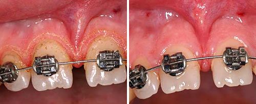 gingivoplasty_dr_gaspirc