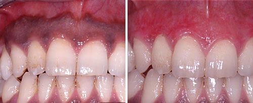gum_pigmentation_dr_maden
