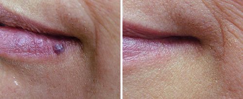 hemangioma_sult_rn
