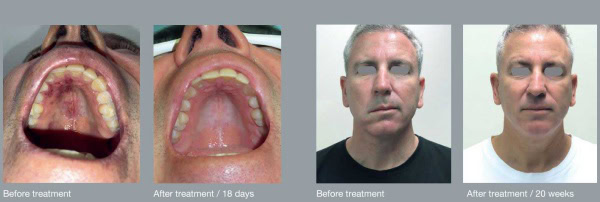 herpes_zoster_infection_b_a2