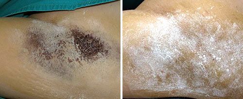 hyperhidrosis2_dr_maletic