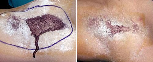 hyperhidrosis_dr_maletic