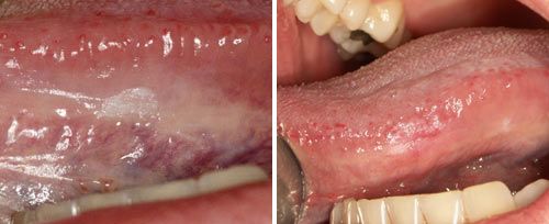 leukoplakia_gabric