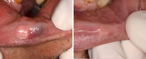 lip_hemangioma2