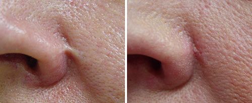 nasal_scar_sult_rn