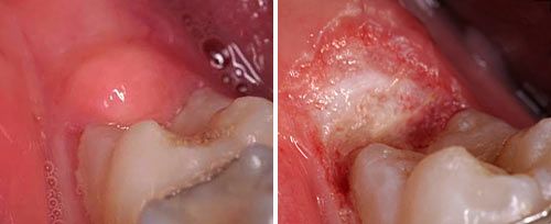 operculectomy_dr_gaspirc