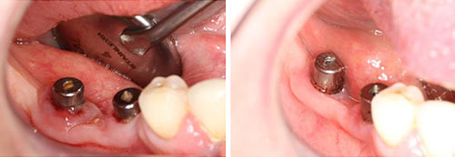 peri_implantitis_bogdan