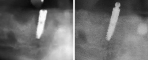 periimplantitis_dr_maden