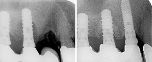 periimplantitis_gokbuket
