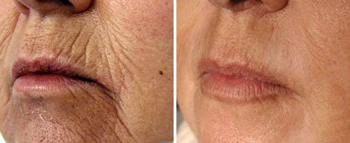 perioral_resurfacing_dr_paciolla