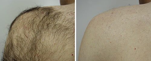 shoulder_hair_reduction_sult_rn