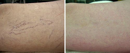 spider_veins_sult_rn