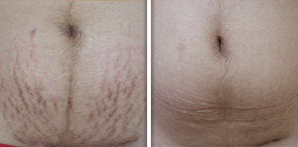 striae_1