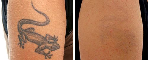 tattoo_removal_dr_ahcan