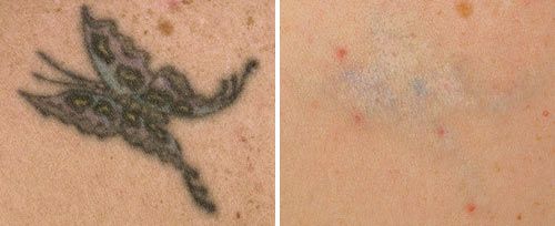tattoo_removal_fotona2