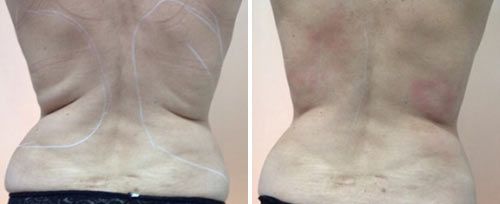 tightsculpting4