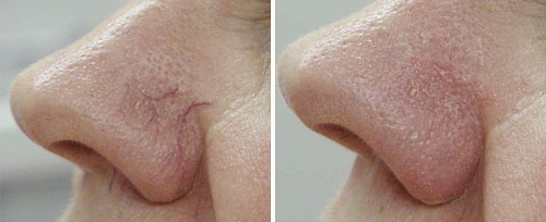 vascular_lesions_b_and_a