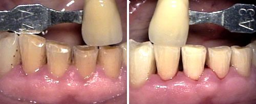 whitening_dr_baldissari