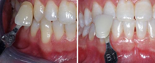 whitening_dr_e_maden_0001