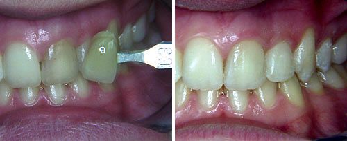 whitening_dr_fornaini_0001