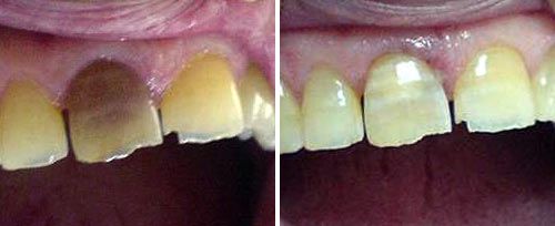 whitening_dr_jovanovic