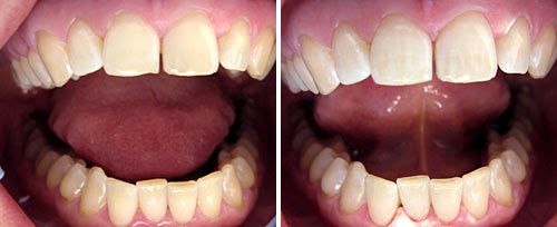 whitening_mironov2