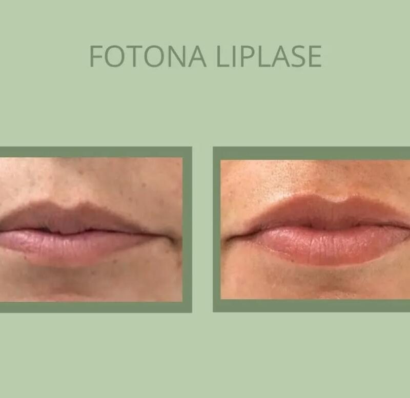 Lip Plumping