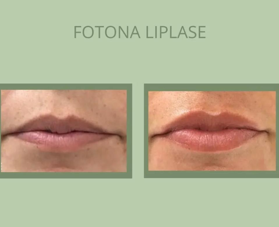 Lip Plumping