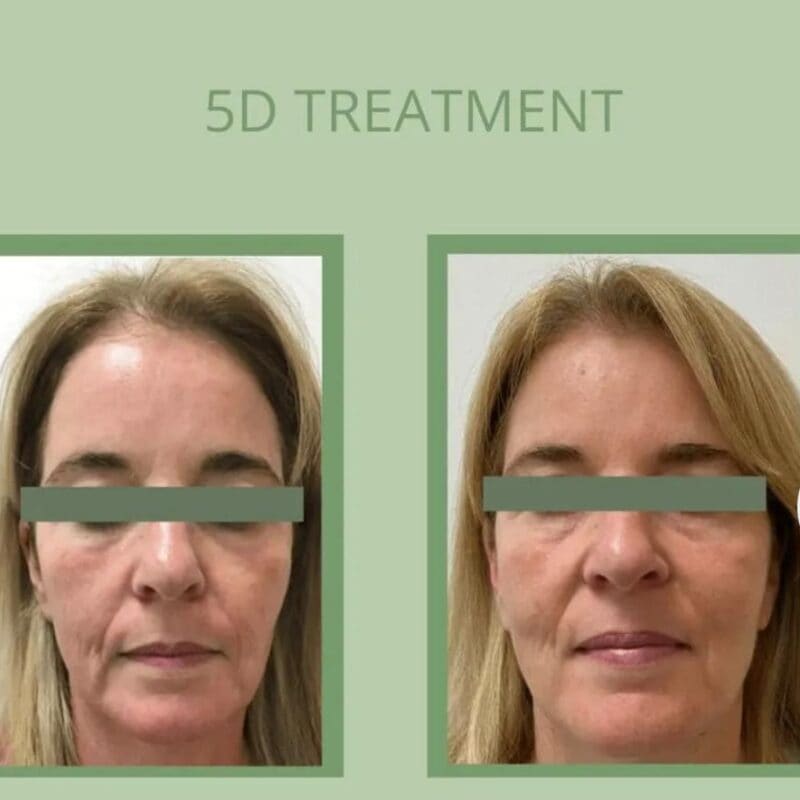 Laser Treatments