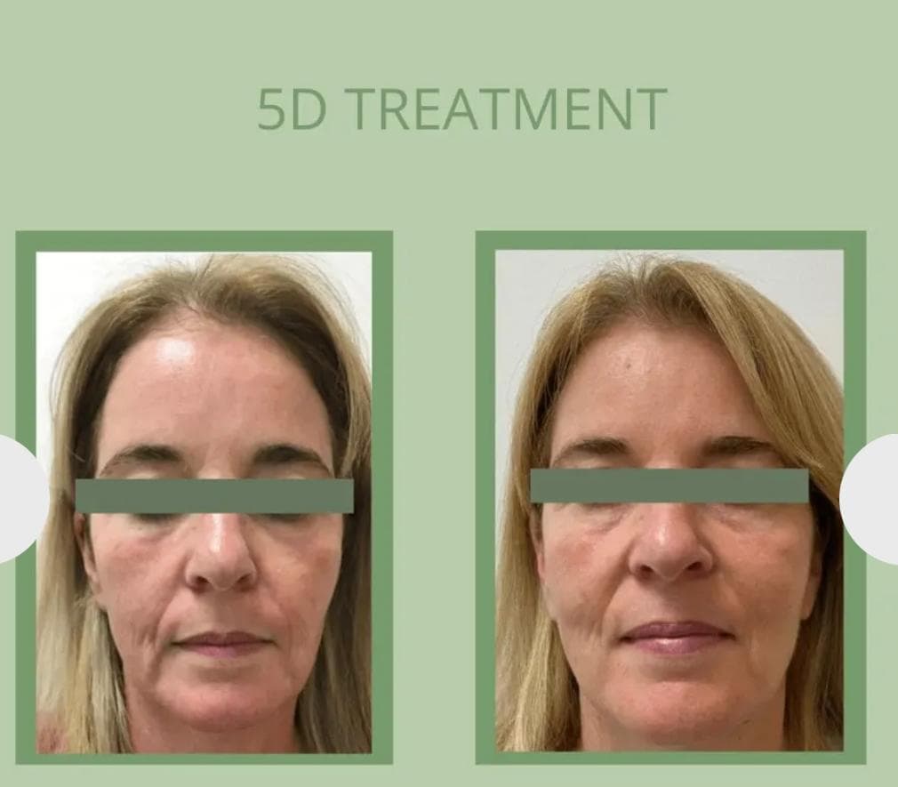Laser Treatments