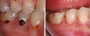 Fotona Lasers in Dentistry